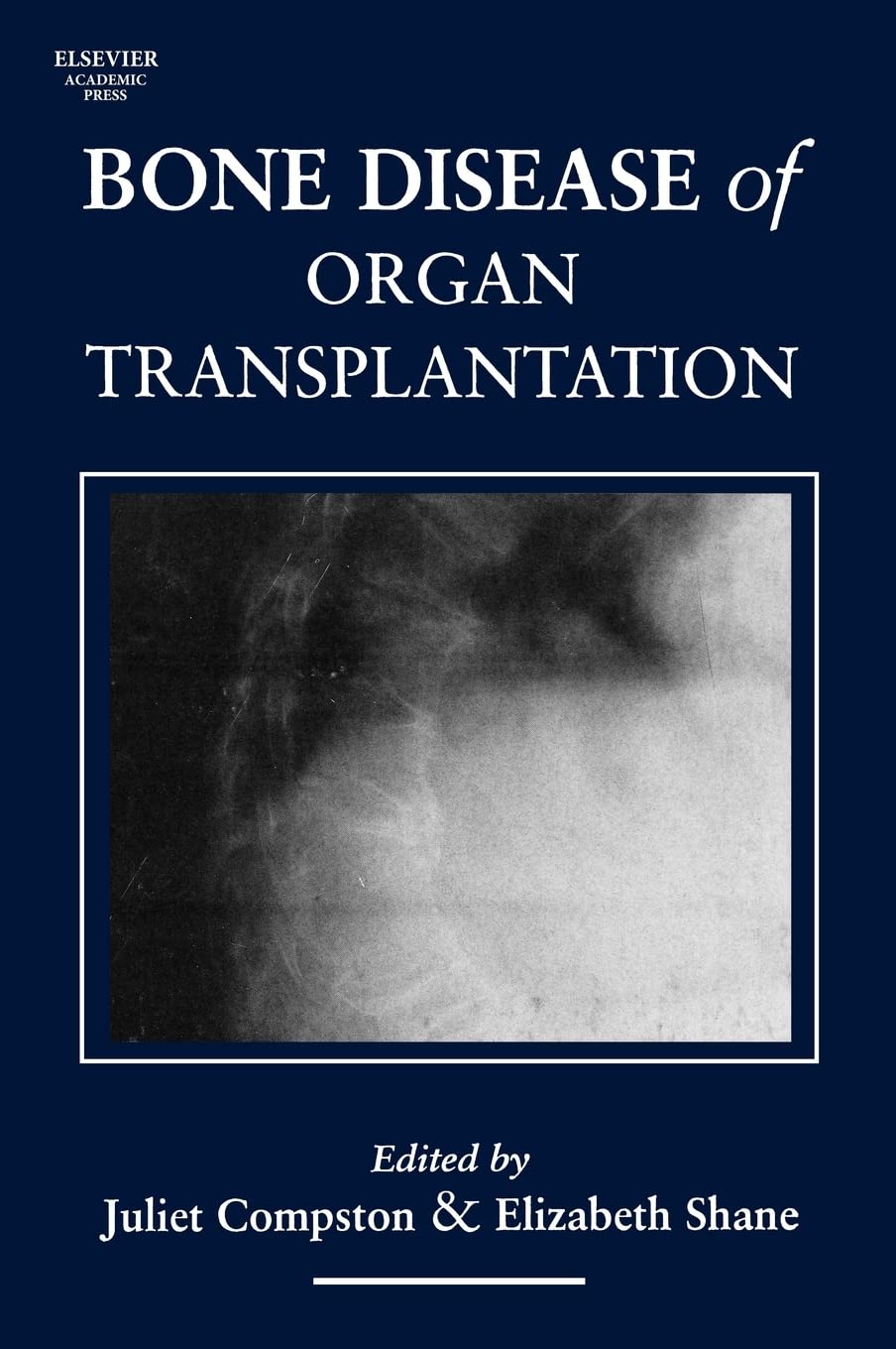 BONE DISEASE OF ORGAN TRANSPLANTATION (Hardcover)