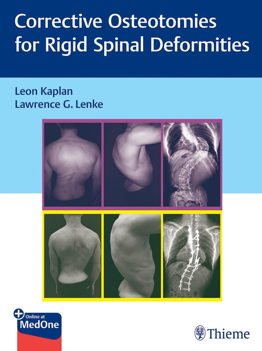 Corrective Osteotomies for Rigid Spinal Deformities 1st Ed.